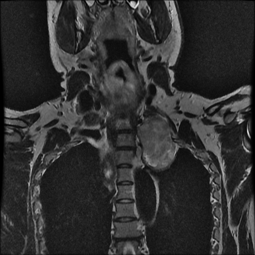 File:Brachial plexus neurofibroma (Radiopaedia 28030-28291 Coronal T2 6).png