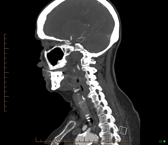 Brachiocephalic trunk stenosis (Radiopaedia 87242-103519 C 26).jpg