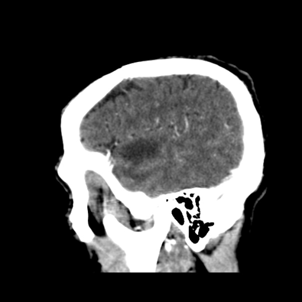 Brain metastases from lung cancer (Radiopaedia 24480-24781 C+ delayed 48).jpg