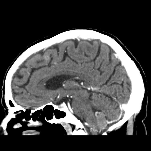 Brain metastasis (Radiopaedia 42617-45760 D 29).jpg