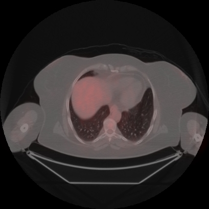 Brain metastasis (Radiopaedia 89847-106962 Axial lung window 46).jpg
