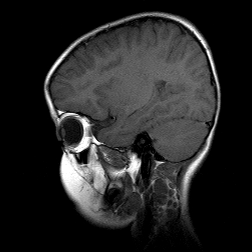 File:Brainstem ganglioglioma (Radiopaedia 10763-11224 Sagittal T1 14).jpg
