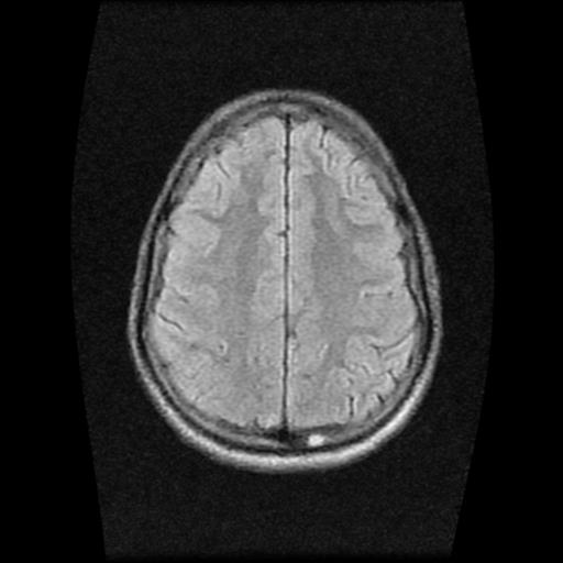 File:Brainstem glioma (Radiopaedia 30923-31624 Axial FLAIR 18).jpg