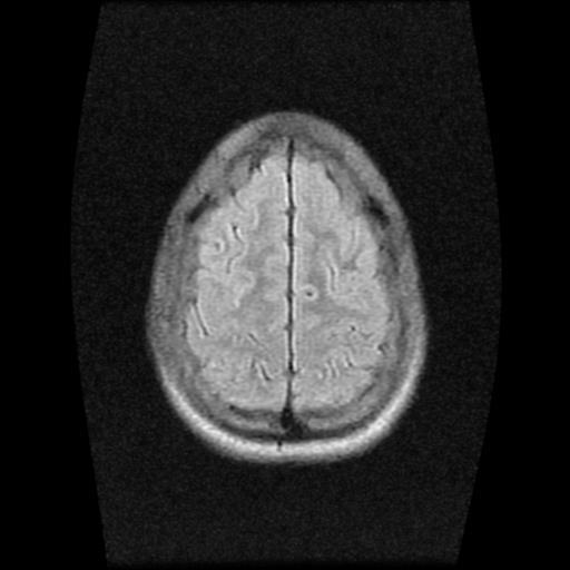 File:Brainstem glioma (Radiopaedia 30923-31624 Axial FLAIR 20).jpg