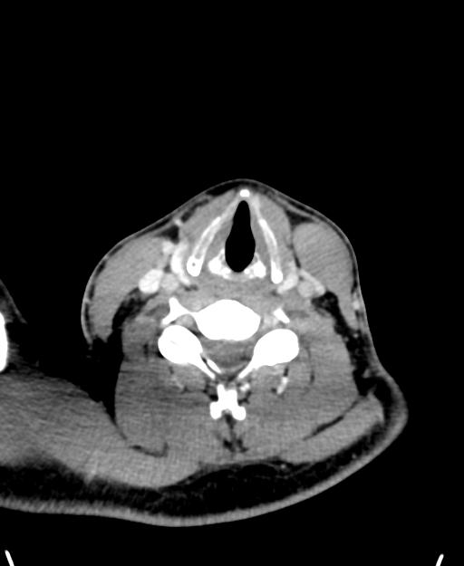Branchial cleft cyst (Radiopaedia 31167-31875 Axial C+ delayed 42).jpg