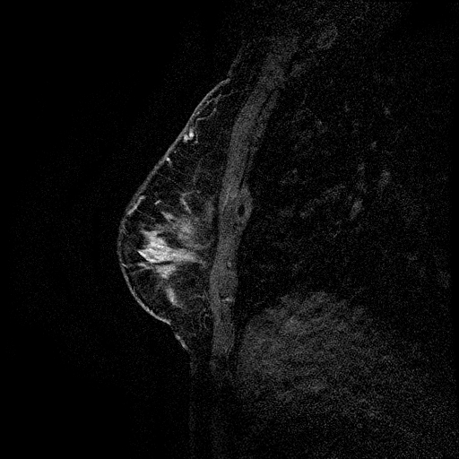 File:Breast lipoma and cancer (Radiopaedia 15118-14995 D 7).jpg