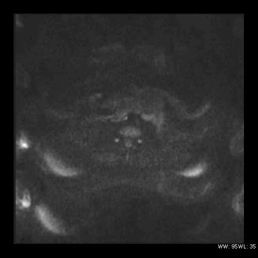 File:Broad ligament fibroid (Radiopaedia 49135-54241 Axial DWI 3).jpg
