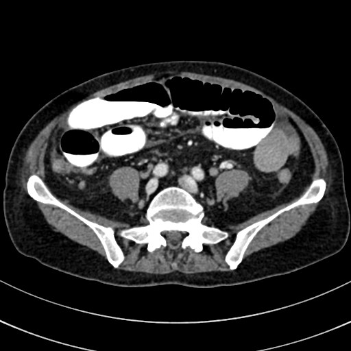 File:Broad ligament hernia (Radiopaedia 84802-100276 A 71).jpg
