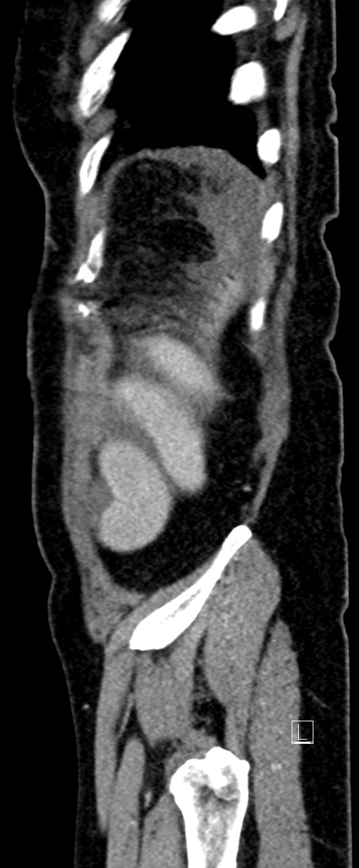 Broad ligament hernia (Radiopaedia 84802-100276 C 3).jpg