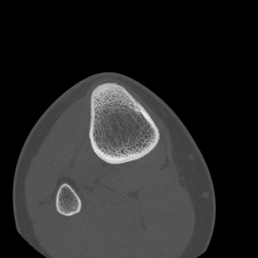 Brodie abscess of the tibia (Radiopaedia 58984-66250 Axial bone window 91).jpg
