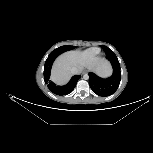 Bronchial carcinoid tumor (Radiopaedia 57187-64090 A 63).jpg
