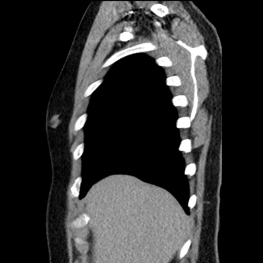 Bronchial carcinoid tumor (Radiopaedia 67377-76764 E 11).jpg