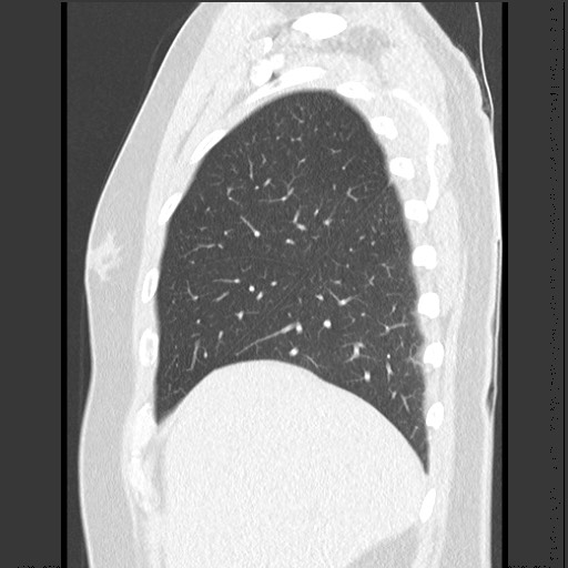 Bronchial carcinoid tumor (Radiopaedia 67377-76764 Sagittal lung window 14).jpg