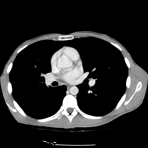 Bronchial carcinoid tumor causing right lower lobe collapse (Radiopaedia 83495-98594 A 25).jpg