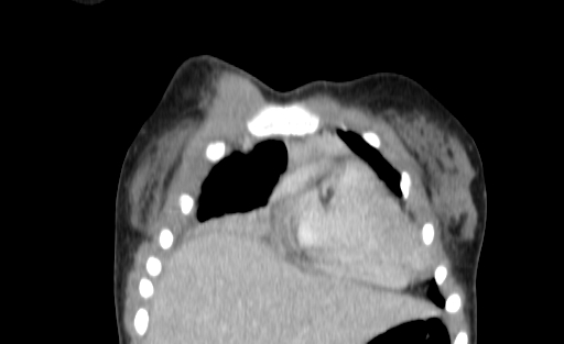 Bronchial mucoepidermoid carcinoma (Radiopaedia 57023-63895 Coronal 10).jpg