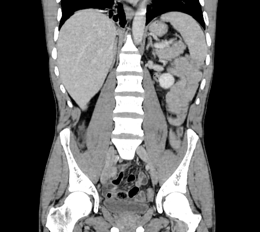 Bronchiectasis in Crohn disease (Radiopaedia 60311-67977 C 47).jpg