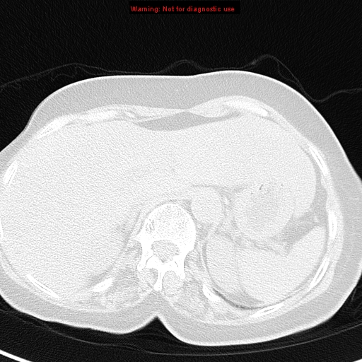 File:Bronchoalveolar carcinoma (BAC) (Radiopaedia 13436-13392 Axial lung window 47).jpg