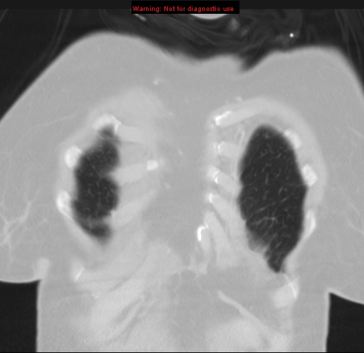 Bronchoalveolar carcinoma (BAC) (Radiopaedia 13436-13392 Coronal lung window 7).jpg