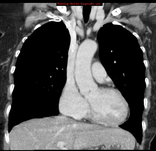Bronchoalveolar carcinoma (BAC) (Radiopaedia 13436-13392 E 22).jpg