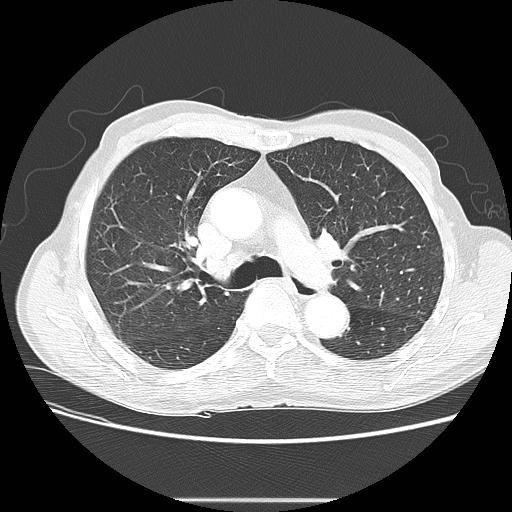Bronchocele (Radiopaedia 17097-16795 Axial lung window 48).jpg