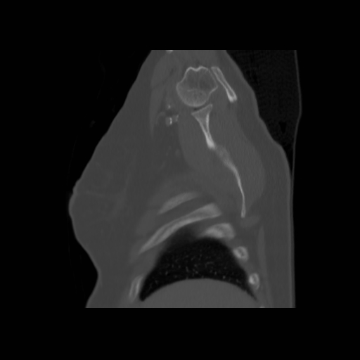 Bronchogenic carcinoma (Radiopaedia 73497-84262 Sagittal bone window 27).jpg