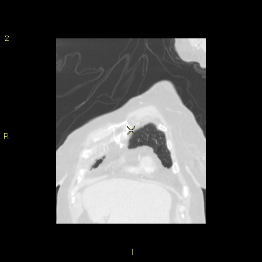 File:Bronchogenic carcinoma as an incidental finding (Radiopaedia 16453-16130 Coronal lung window 12).jpg