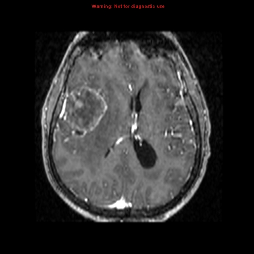 File:Bronchogenic carcinoma brain metastasis (Radiopaedia 9286-9969 Axial T1 C+ 7).jpg