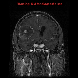 File:Bronchogenic carcinoma brain metastasis (Radiopaedia 9286-9969 Coronal T1 22).jpg