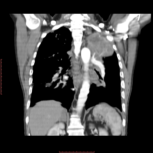File:Bronchogenic carcinoma with left atrial large deposit - T4N3M1a (Radiopaedia 42316-45428 B 11).jpg