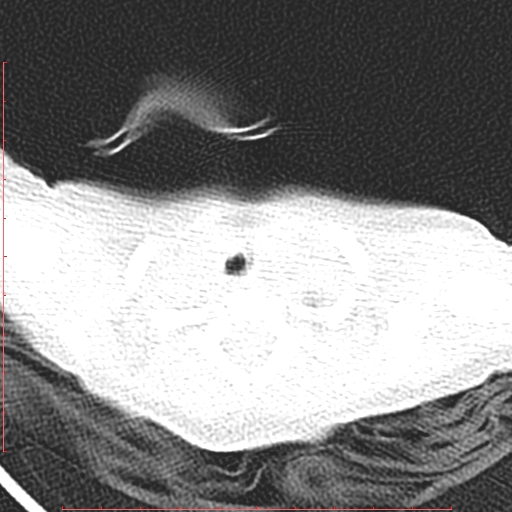 Bronchogenic cyst (Radiopaedia 78599-91409 Axial lung window 17).jpg