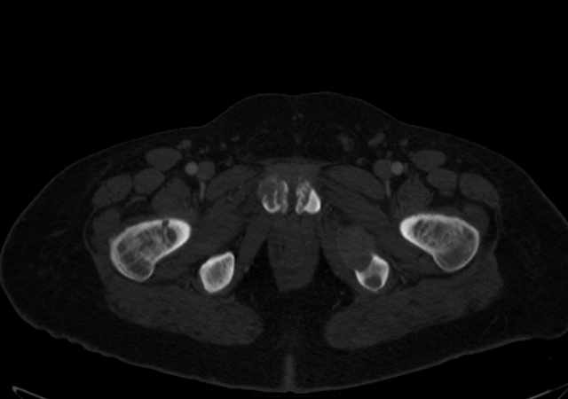 Brown tumors compressing the spinal cord (Radiopaedia 68442-77988 G 130).jpg