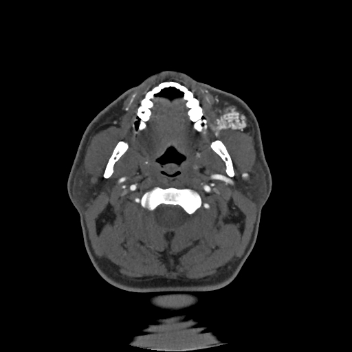 Buccal fat pad arteriovenous malformation (Radiopaedia 70936-81144 A 55).jpg