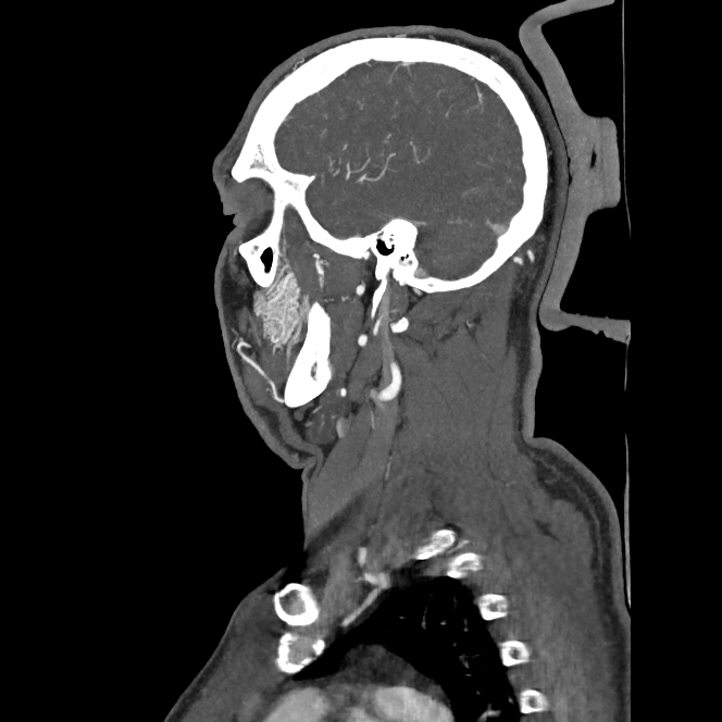 Buccal fat pad arteriovenous malformation (Radiopaedia 70936-81144 C 33).jpg