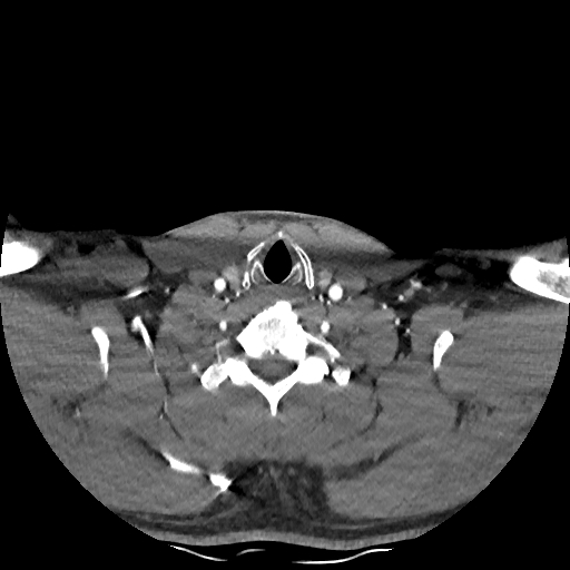 Buccal fat pad arteriovenous malformation (Radiopaedia 70936-81144 D 76).jpg