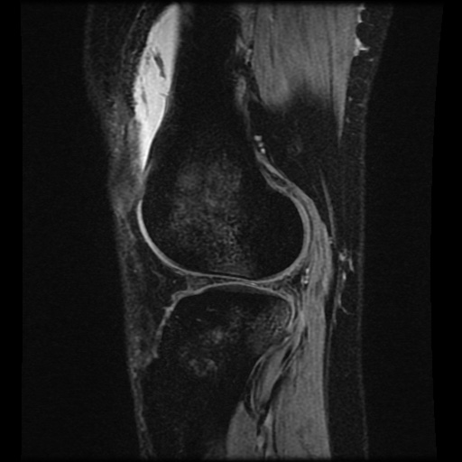 Bucket handle meniscus tear (Radiopaedia 56916-63751 H 20).jpg