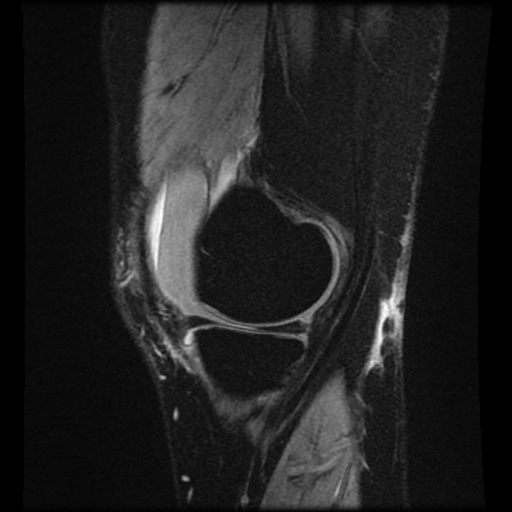 Bucket handle meniscus tear (Radiopaedia 56916-63751 H 67).jpg