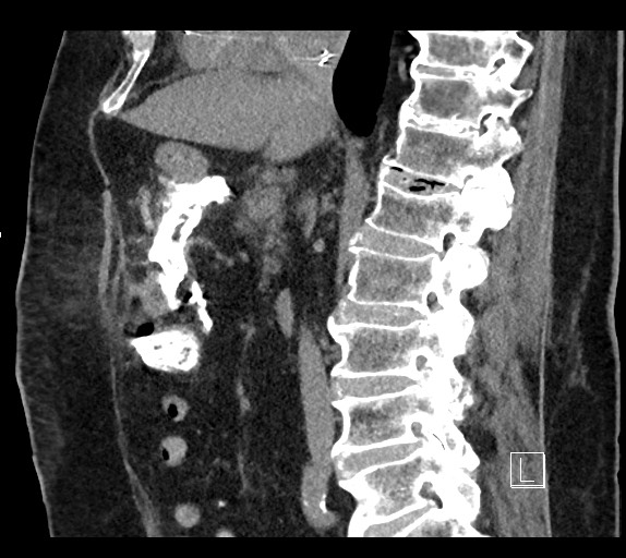 Buried bumper syndrome - gastrostomy tube (Radiopaedia 63843-72577 Sagittal Inject 65).jpg
