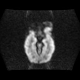 File:Burkitt lymphoma of the orbit- pre and post chemotherapy (Radiopaedia 31214-31929 Axial DWI 6).jpg