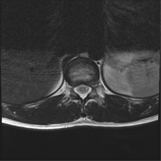 File:Burst fracture - T12 with conus compression (Radiopaedia 56825-63646 Axial T2 23).png