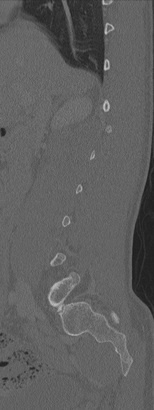 Burst fracture - T12 with conus compression (Radiopaedia 56825-63647 Sagittal bone window 63).png