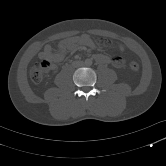 Burst fracture with cauda equina syndrome (Radiopaedia 25701-25867 Axial bone window 99).jpg