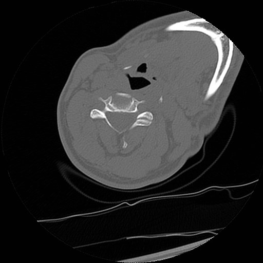 C1-C2 "subluxation" - normal cervical anatomy at maximum head rotation (Radiopaedia 42483-45607 Axial non-contrast 9).jpg
