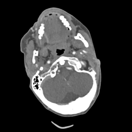 C2 fracture with vertebral artery dissection (Radiopaedia 37378-39200 A 186).png