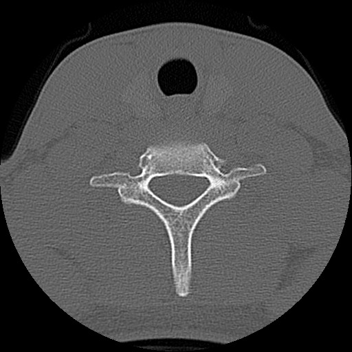 File:C5 facet fracture (Radiopaedia 58374-65499 Axial bone window 70).jpg