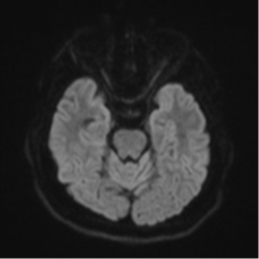 File:CNS vasculitis (Radiopaedia 55715-62263 Axial DWI 39).png