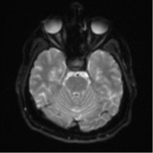 File:CNS vasculitis (Radiopaedia 55715-62263 Axial DWI 9).png