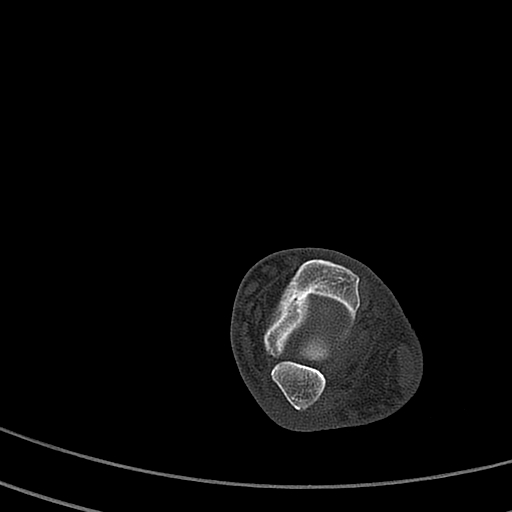 Calcaneal fracture - Sanders type 4 (Radiopaedia 90179-107370 Axial bone window 21).jpg