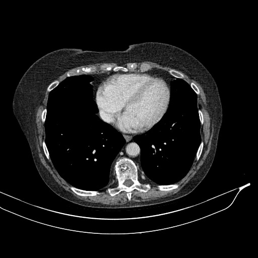 Calcified adrenal glands and Spigelian hernia (Radiopaedia 49741-54988 A 4).jpg