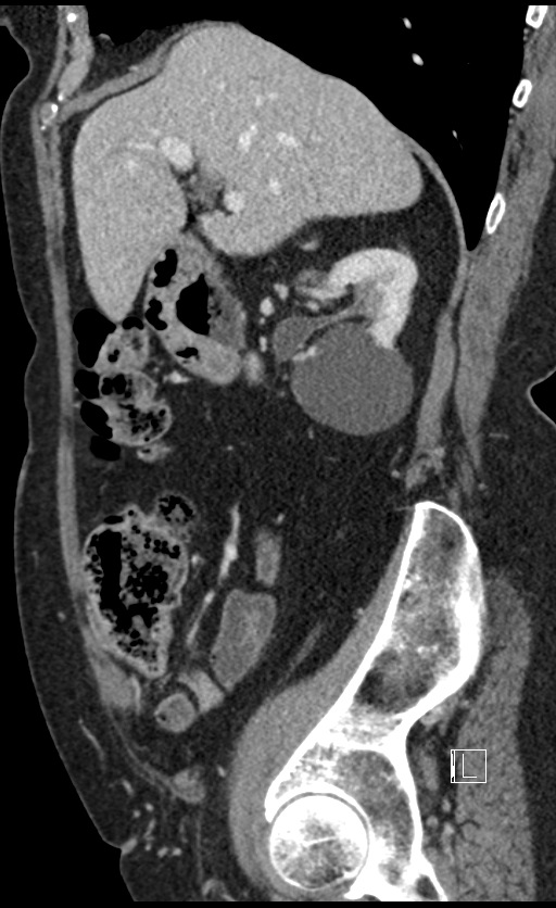 Calcified adrenal glands and Spigelian hernia (Radiopaedia 49741-54988 C 113).jpg
