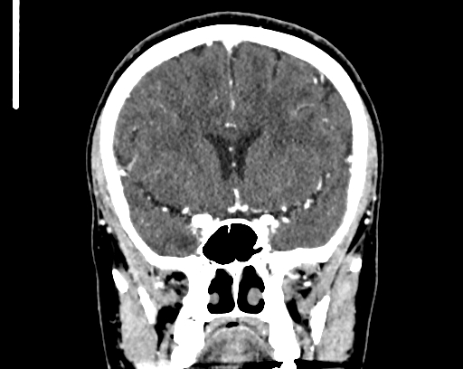 Calcified cerebral hydatid cyst (Radiopaedia 65603-74717 C 26).jpg